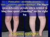 BLOUNT DISEASE/Golenie szpotawe/LECTURE/Knee Valgus Deformity/Prague/19.10.07